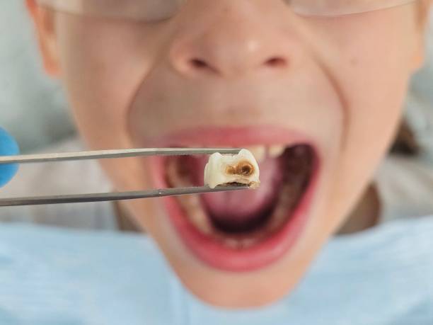 Best Emergency Wisdom Teeth Removal in Underwood, IA